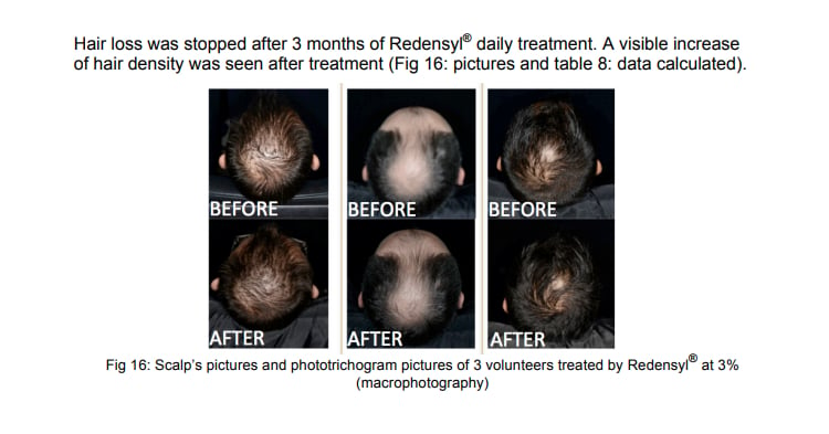 Redensyl treatment for hair loss
