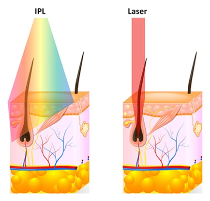 IPL vs. laser hair removal